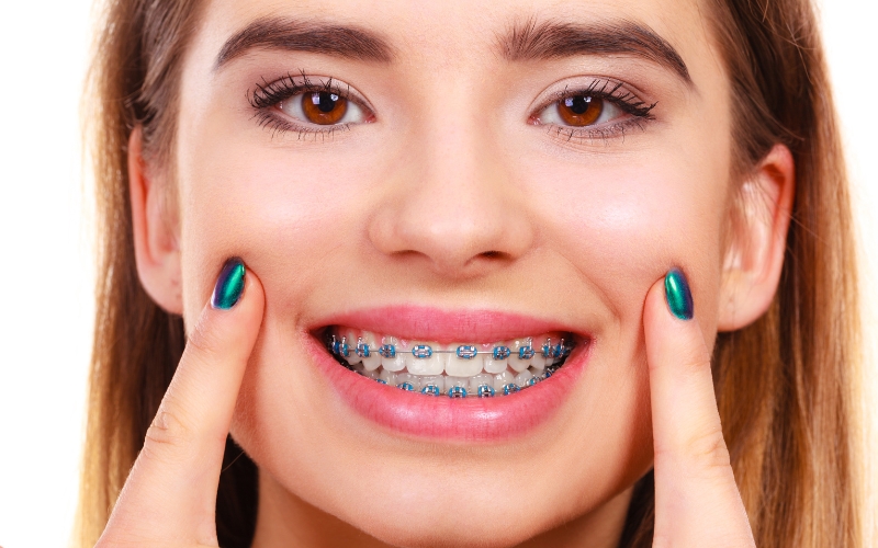 Getting Braces? What to Expect.
