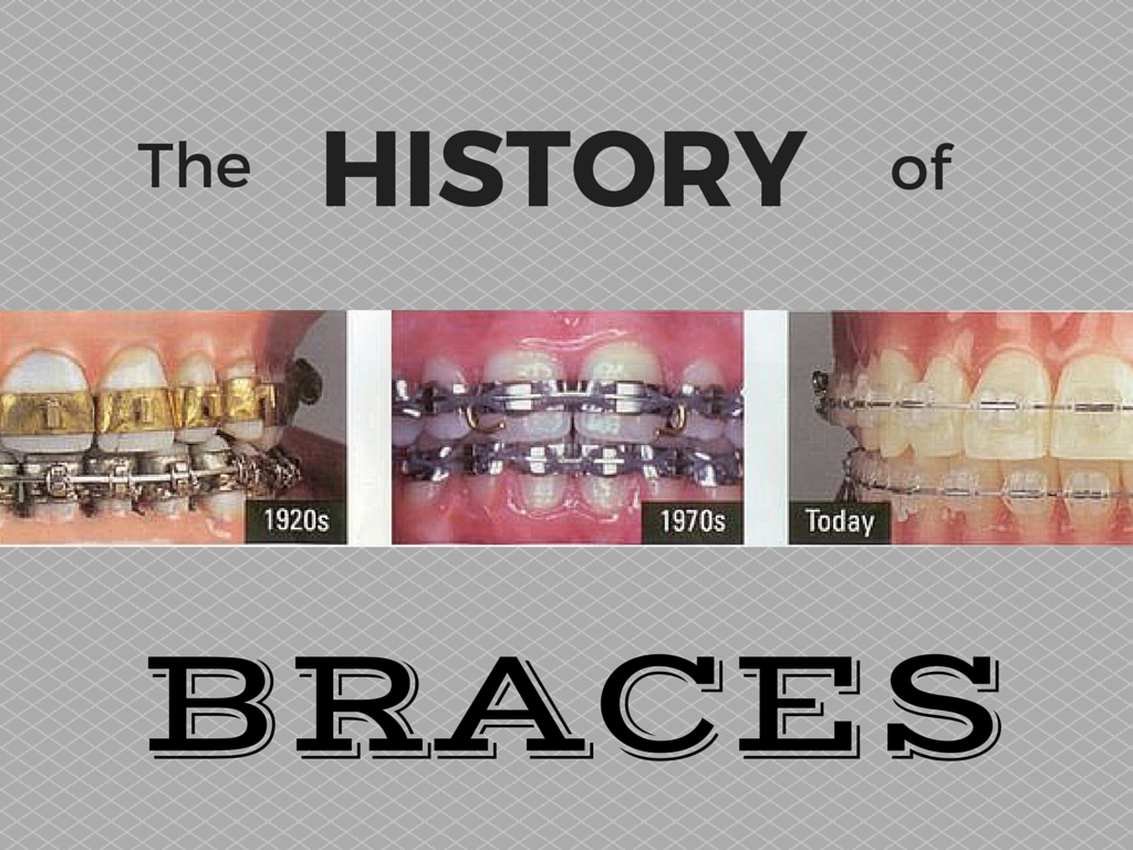 The History of Braces Blog