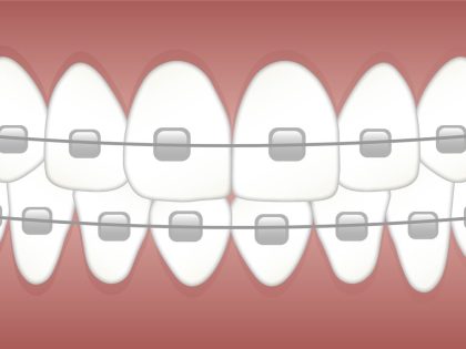 What you need to know to keep your teeth straight